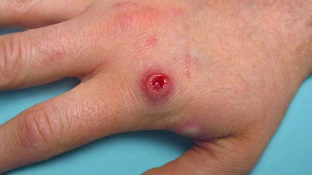 ทำความเข้าใจกับ Monkeypox และวิธีป้องกัน？