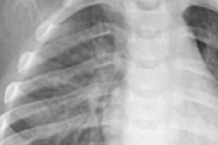 การตรวจจับ Chlamydia pneumoniae อย่างรวดเร็ว: เชื่อถือได้และมีประสิทธิภาพ